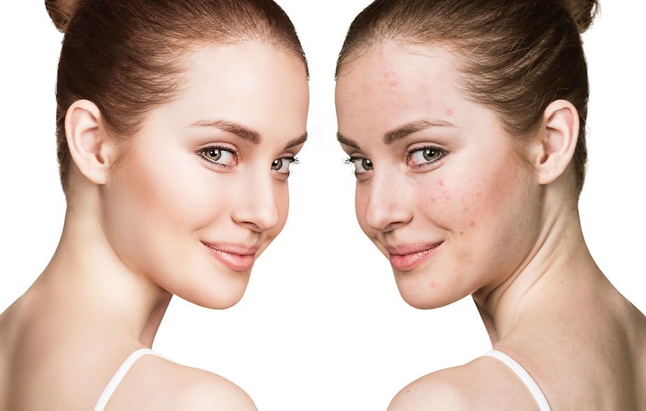 You are currently viewing Chemical Peeling: an acne treatment